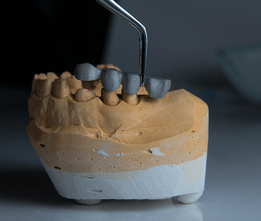 Tooth Bridge
