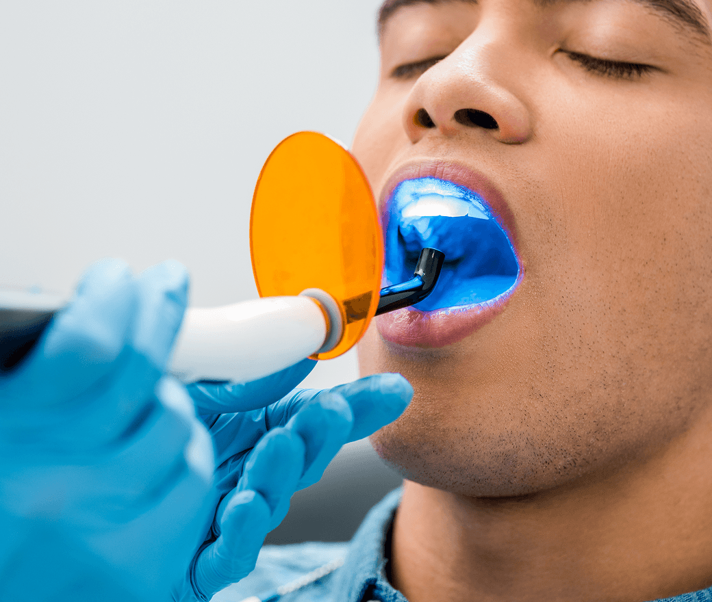 Tooth Filling