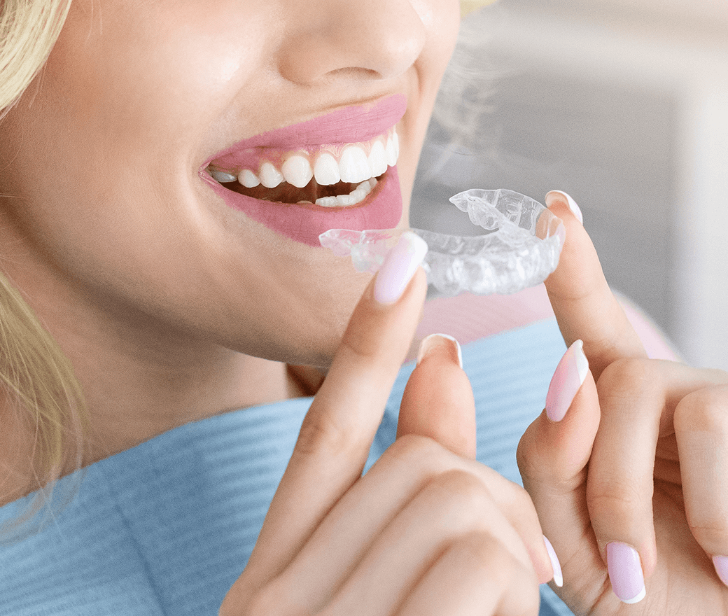 Invisalign Aligners