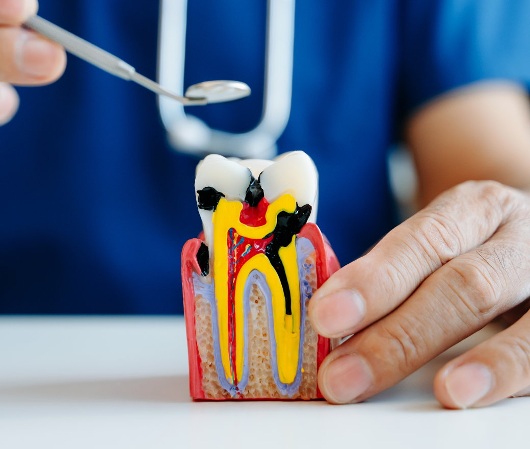 Root Canal Treatment