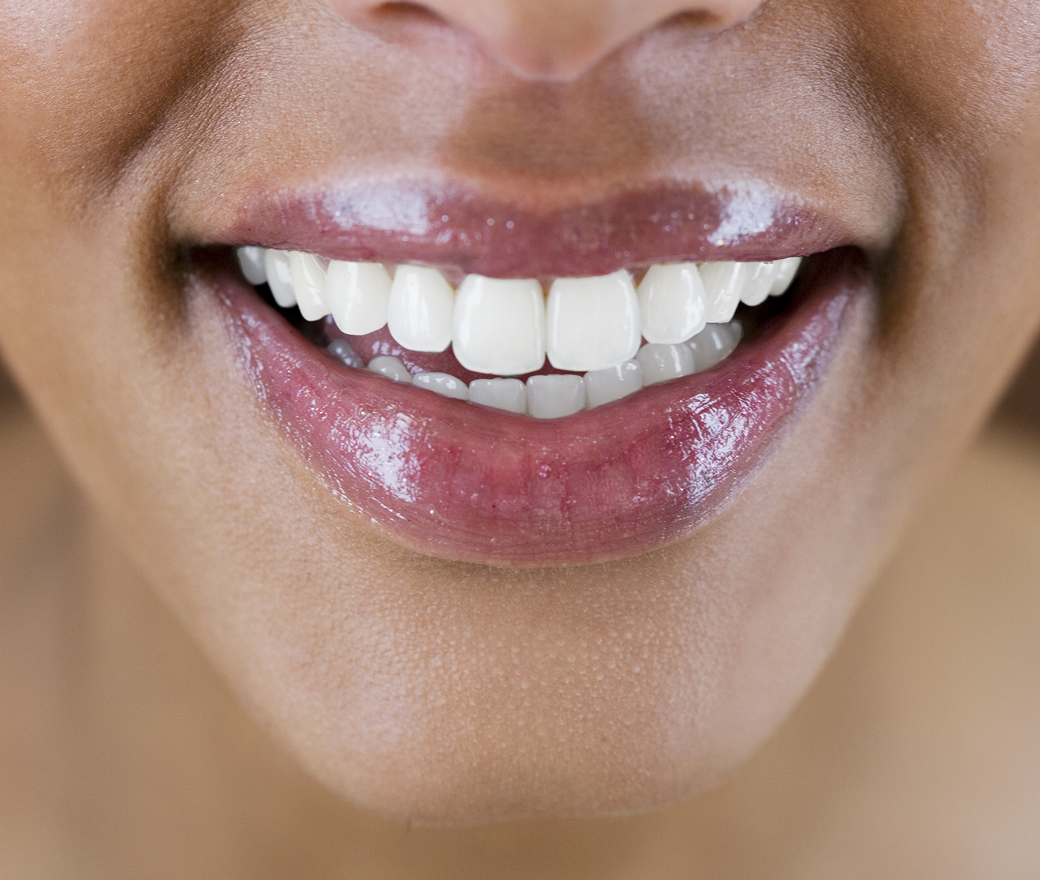 Professional Teeth Whitening