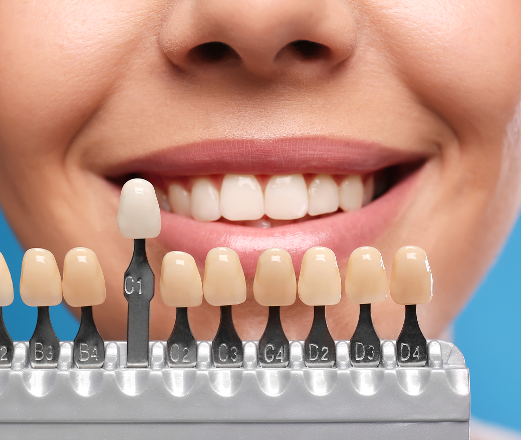Composite Resin Veneers