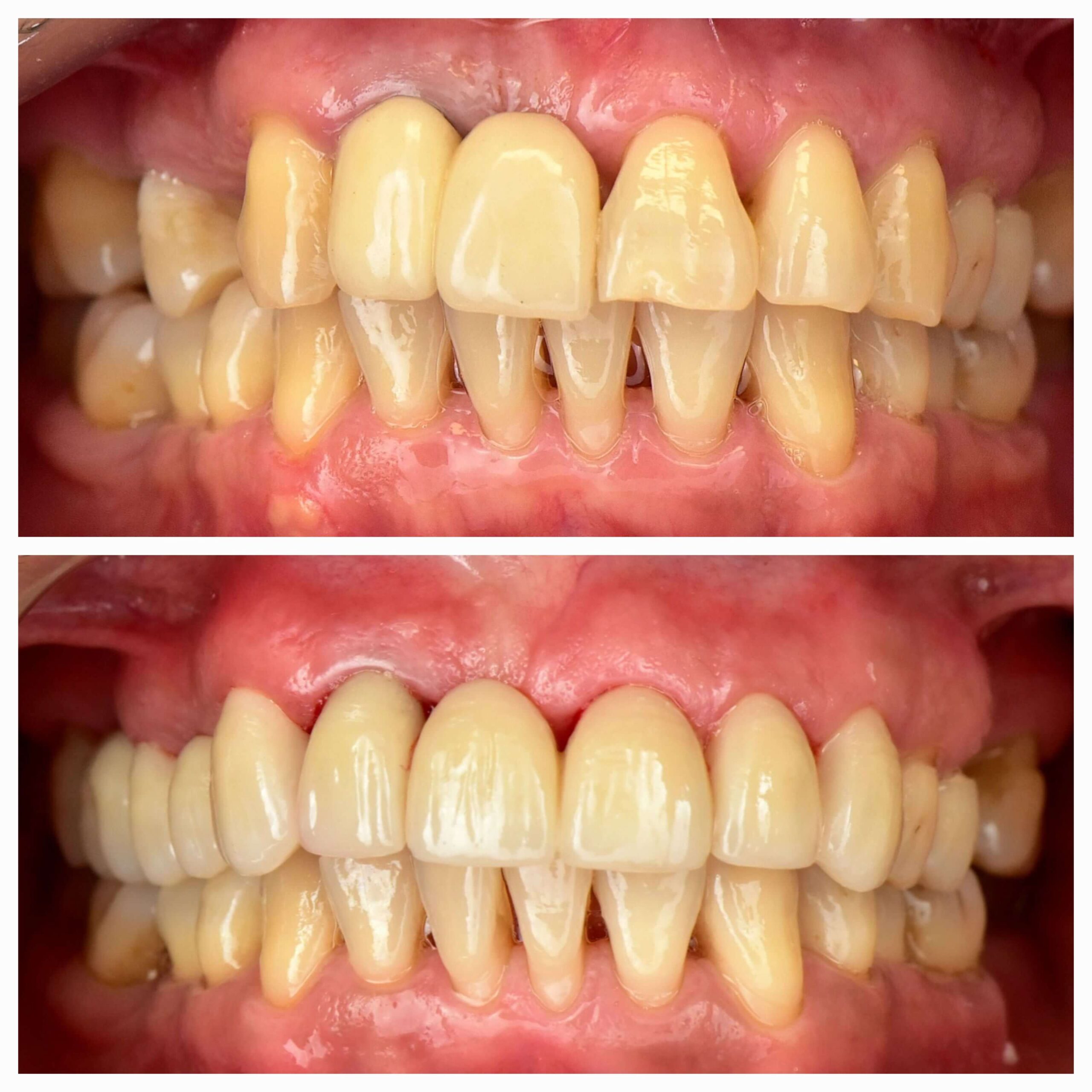 Root Canal, Crown & Bridge - Case 1