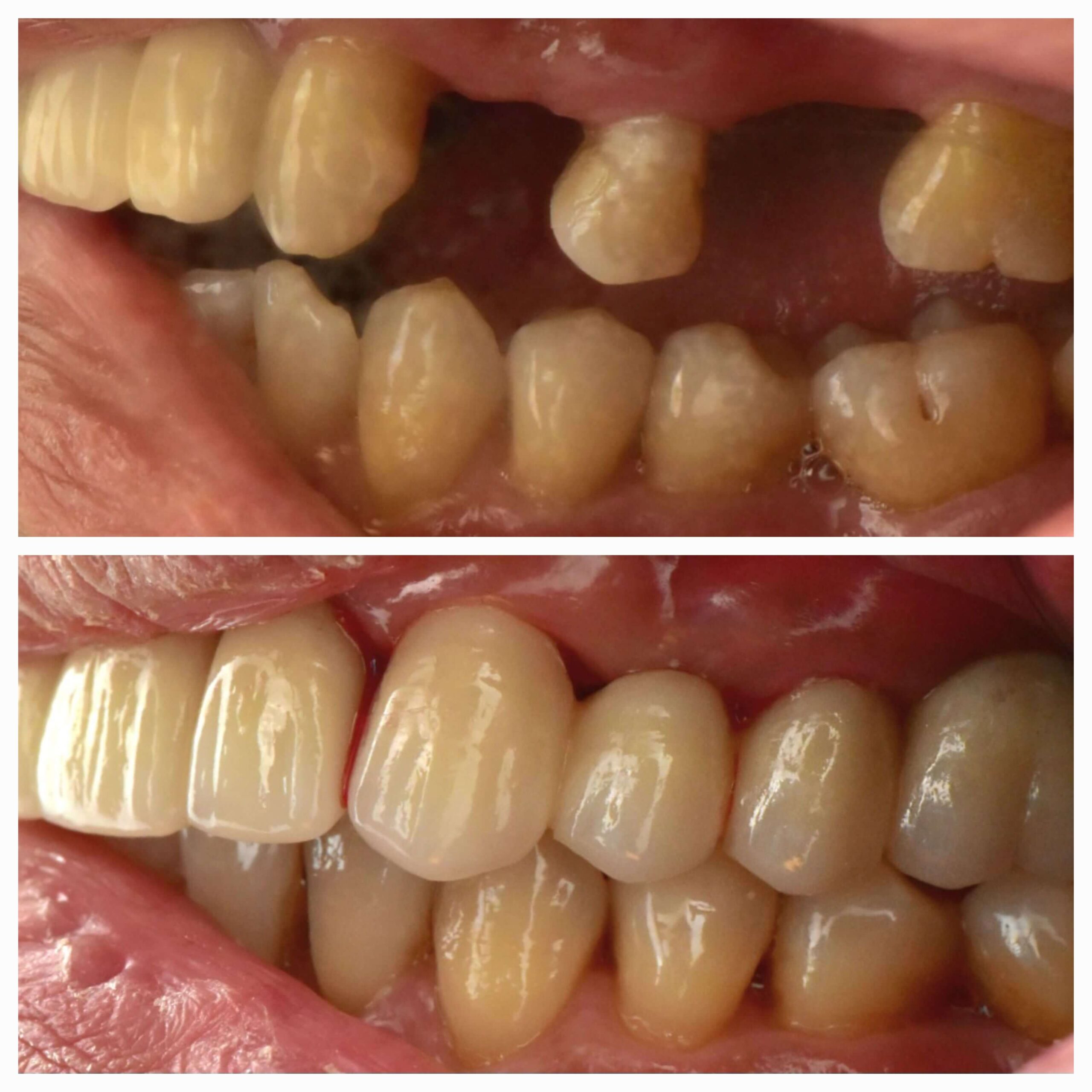 Root Canal, Crown & Bridge - Case 1