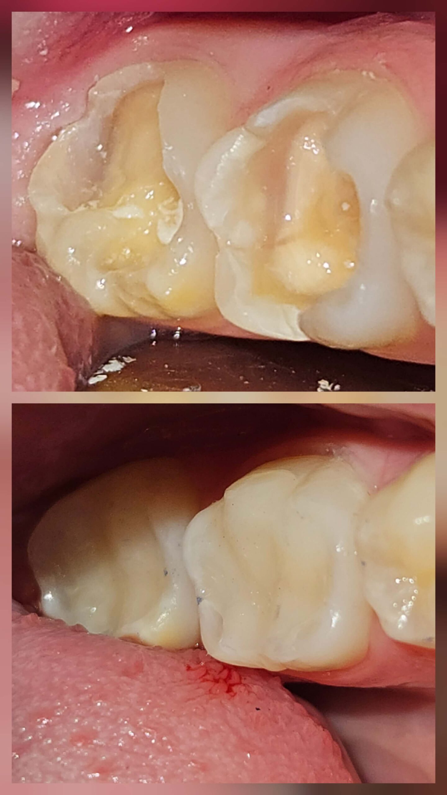 Composite Molar Restorations - Case 1