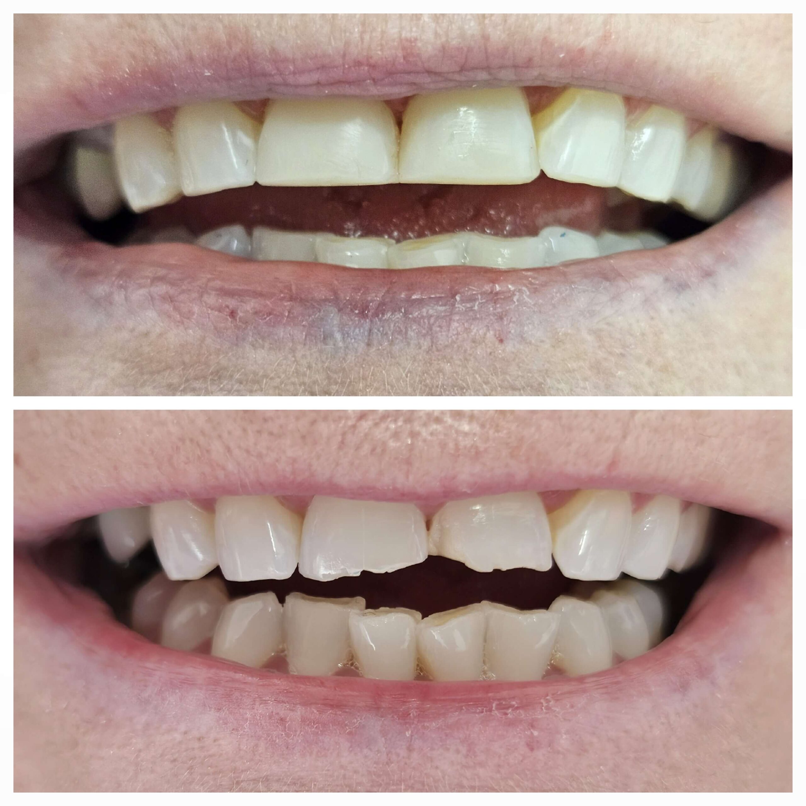 Composite Veneers - Case 1