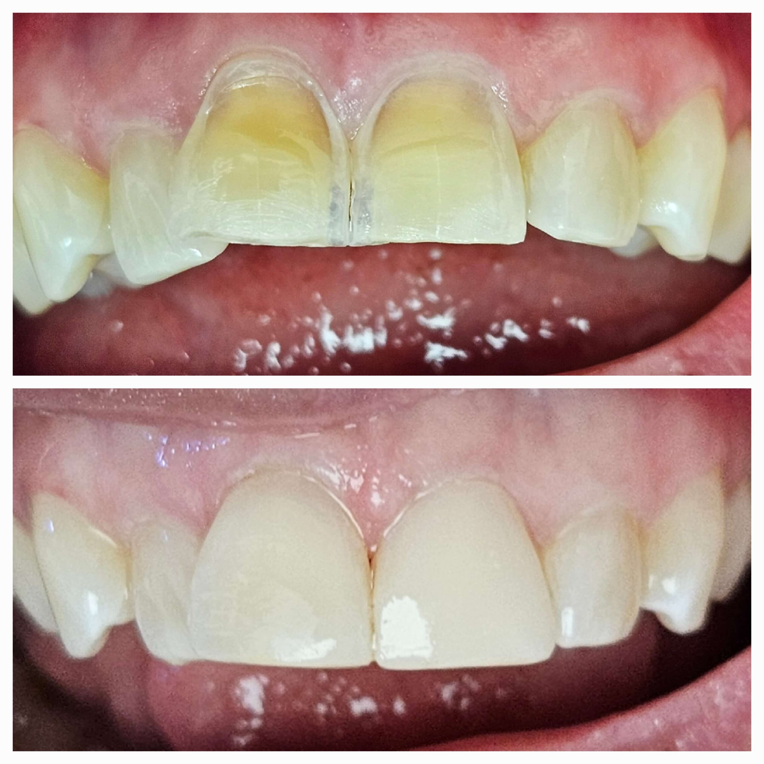 Composite Veneers - Case 2