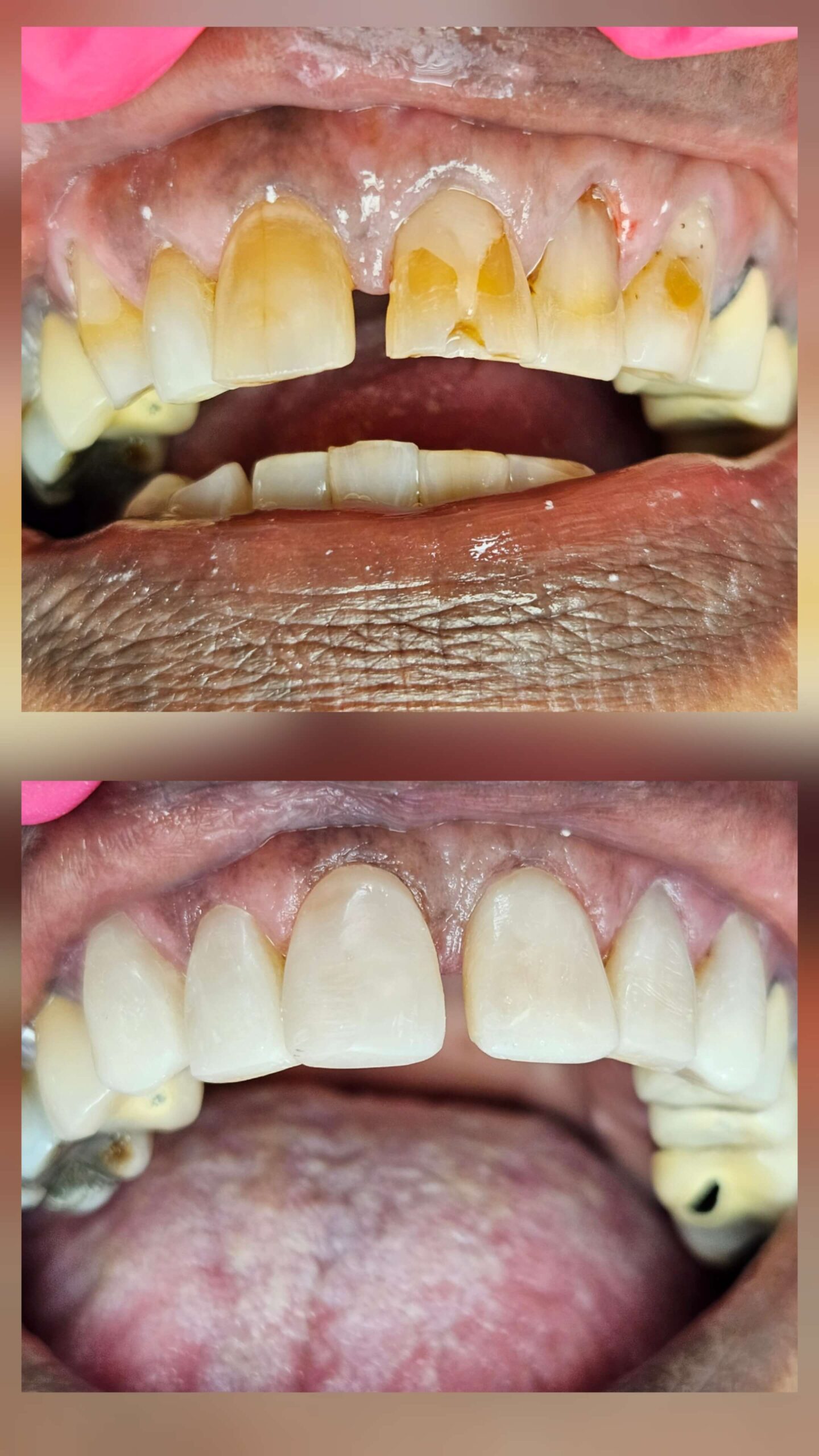 Composite Veneers - Case 3