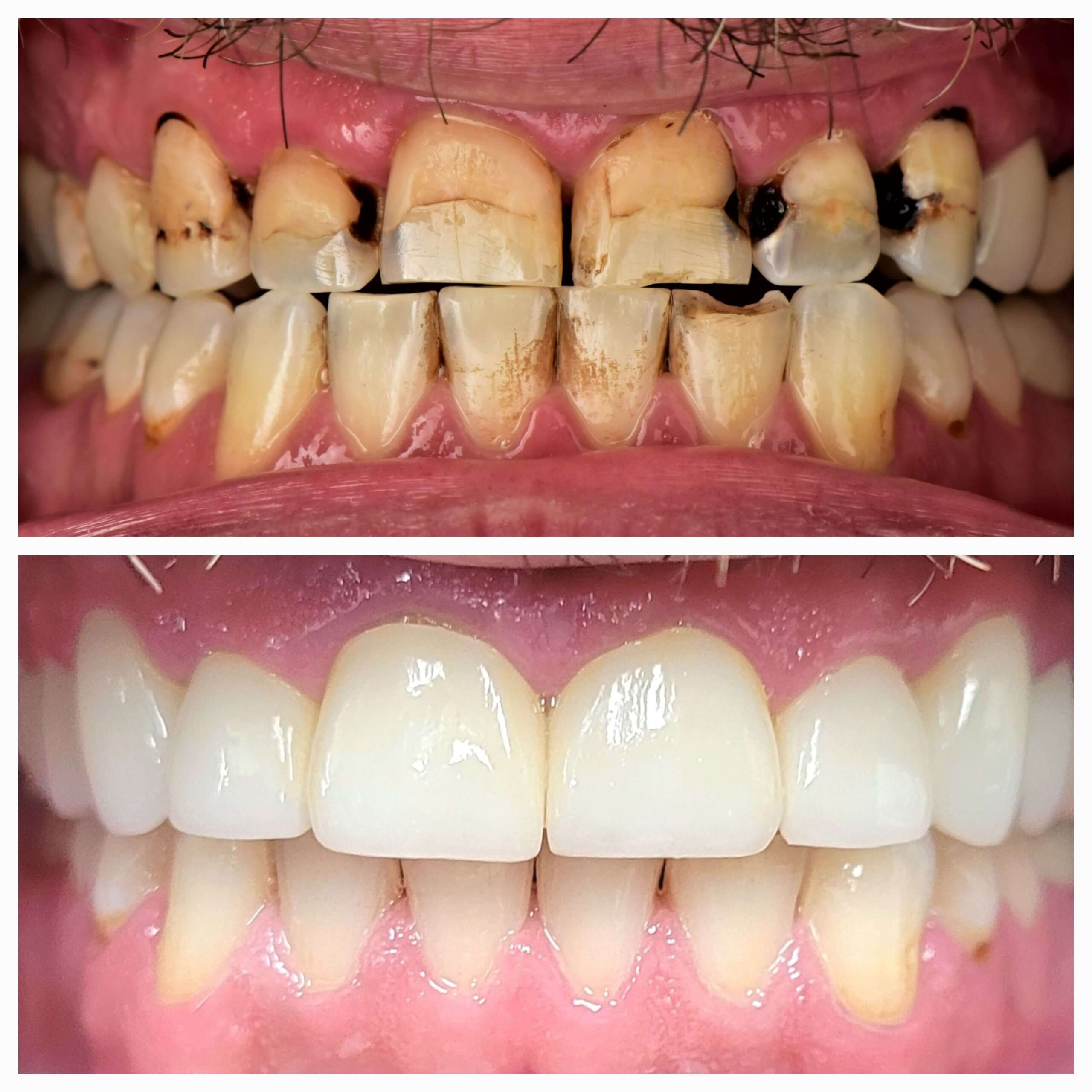 Root Canal & Crowns - Case 1