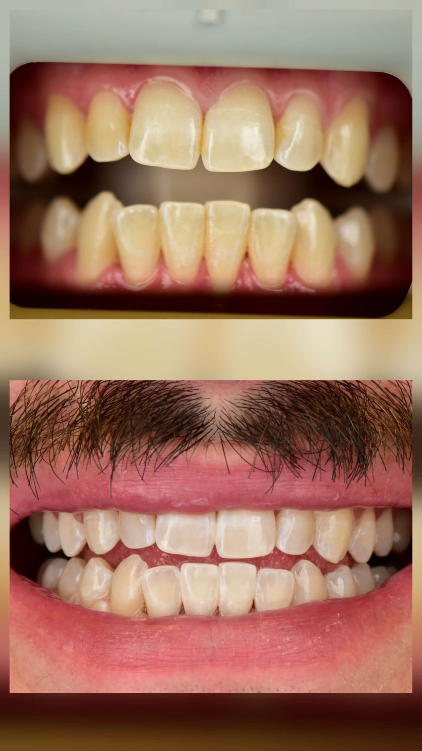 Professional Whitening - Case 1